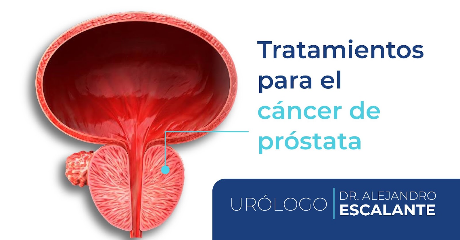 tratamiento_cancer_de_prostata